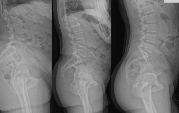 What Factors Affect the Placement of the Acetabular Component? – Navbit