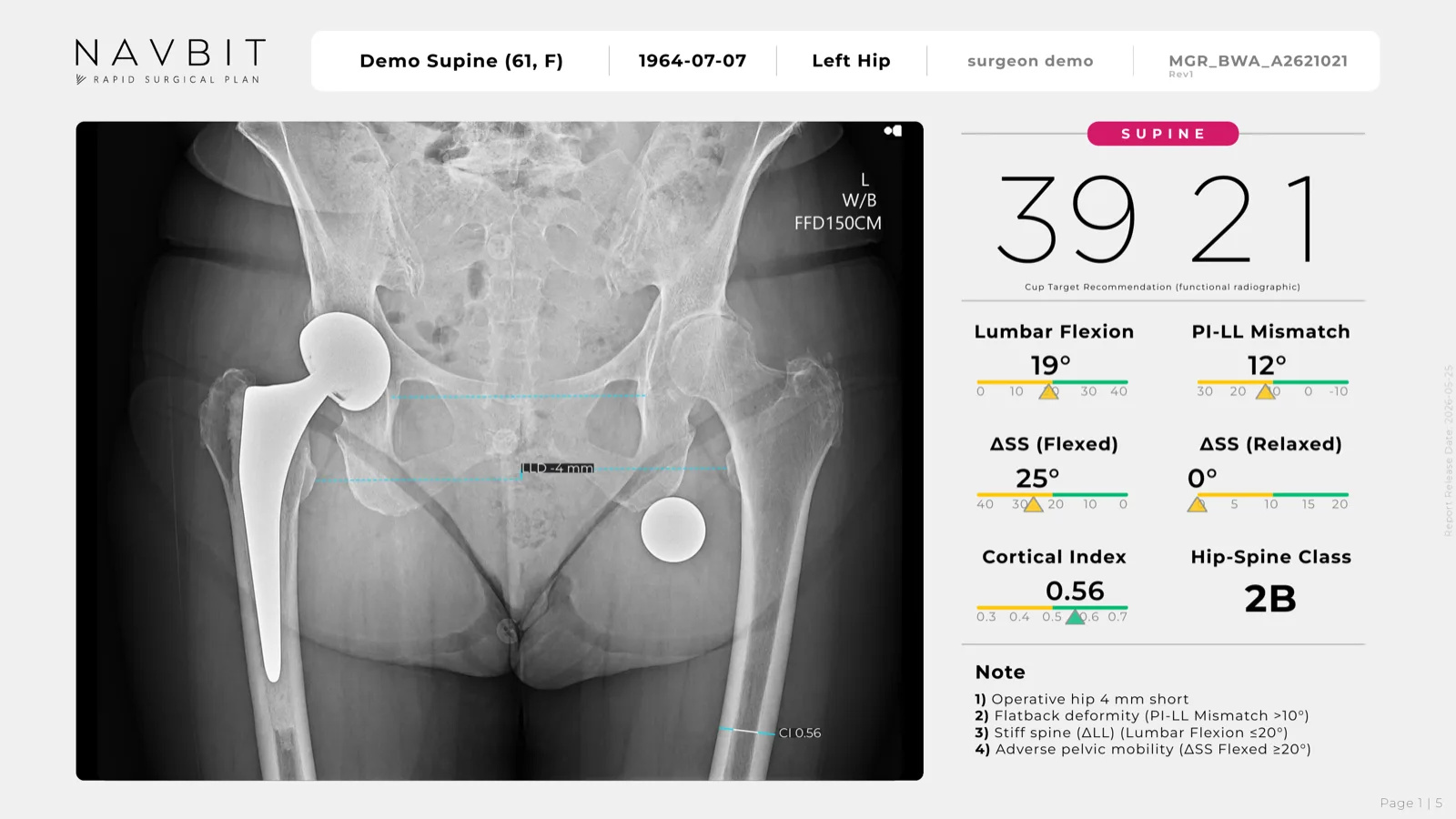 RAPID surgical plan, page 1: AP pelvis radiograph with a supine cup target of 39 / 21 and spinopelvic gauges